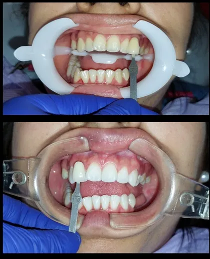 Antes y después de blanqueamiento dental en Odonto Maoli