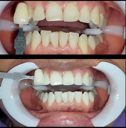 Resultado de blanqueamiento dental en Odonto Maoli
