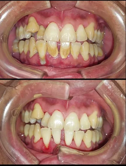 Antes de limpieza dental profunda en Odonto Maoli