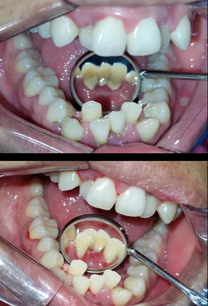 Después de limpieza dental profunda en Odonto Maoli