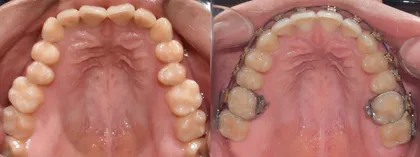 Resultado de tratamiento de ortodoncia en Odonto Maoli