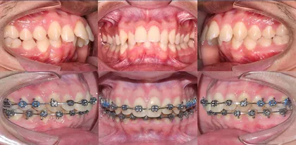 Paciente con brackets durante tratamiento de ortodoncia