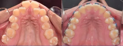 Seguimiento de tratamiento de ortodoncia en Odonto Maoli