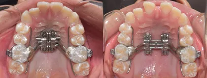 Aparato de expansión palatal (MARPE) usado en ortodoncia