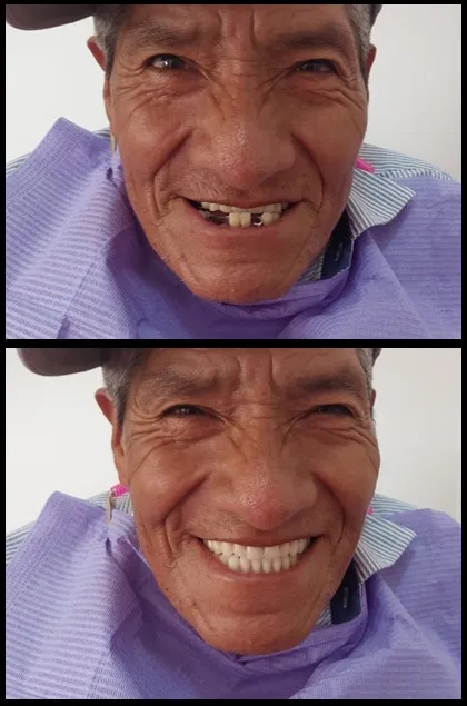 Antes y después de prótesis dental total en Odonto Maoli