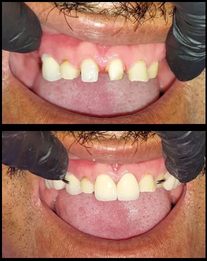 Procedimiento de rehabilitación oral con coronas