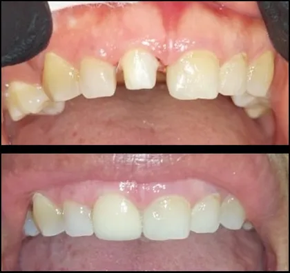 Resultado de rehabilitación oral con coronas de metal-porcelana