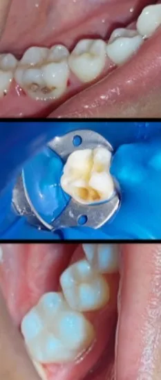Procedimiento de restauración estética dental