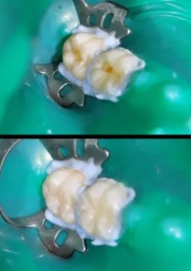 Restauración estética dental en proceso