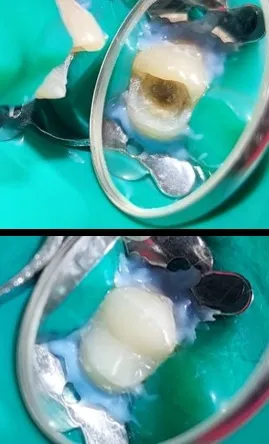 Resultado de restauración estética dental